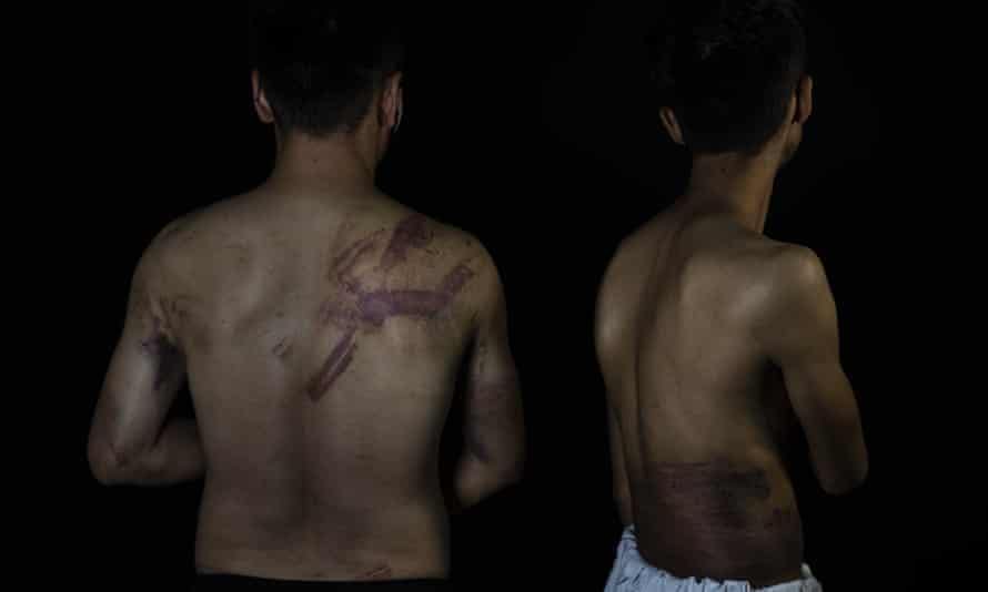 Two Afghan reporters show the wounds after they were beaten by Taliban