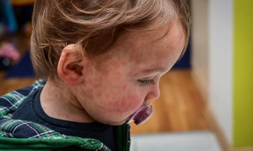 Warning over use of anti-choking suction devices on children