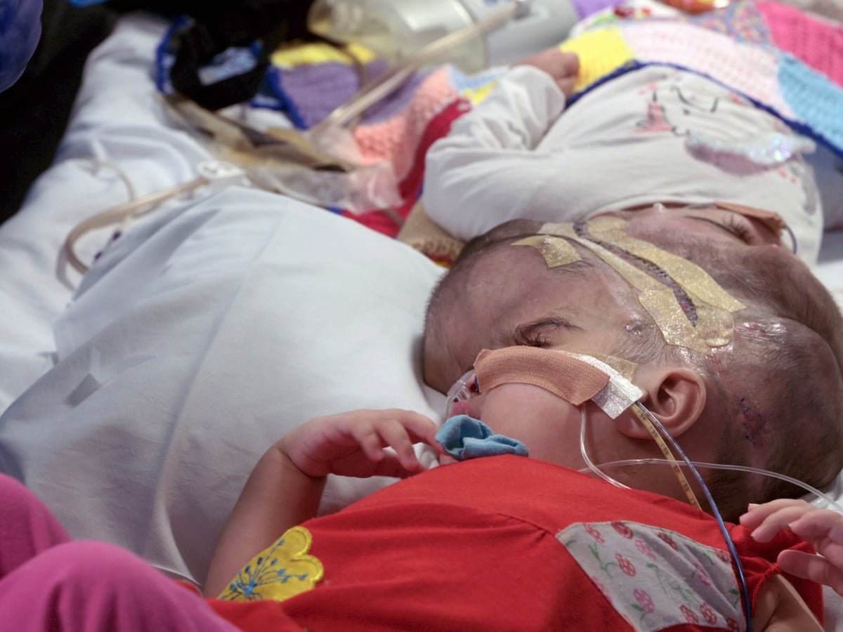 Separating Conjoined Twins Is A Stressful High Risk Operation It S Why I Went Into Medicine As Told To Sarah Johnson The Guardian