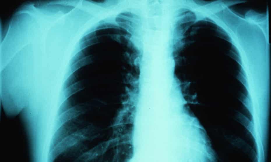 X ray of an asthmatic patient’s chest.