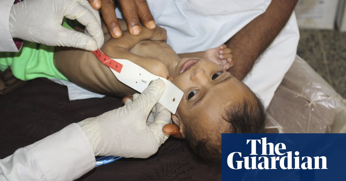 UK aid cuts will put tens of thousands of children at risk of famine, says charity - The Guardian