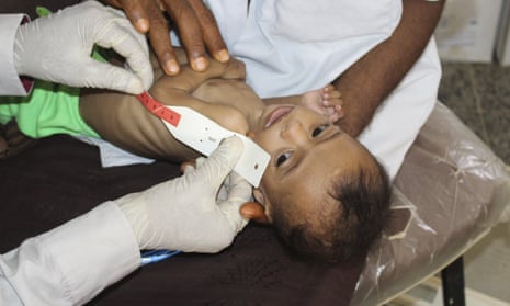 A seven-month-old baby is measured at a clinic in Deir Al-Hassi, Yemen.