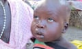 Child with post-kala-azar-dermal leishmaniasis in old Fangak County, South Sudan. The area suffered severe visceral leishmaniasis outbreaks from 2009 to 2012.
