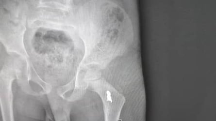 An X-ray of a boy’s thigh shows a foreign body near the hip socket