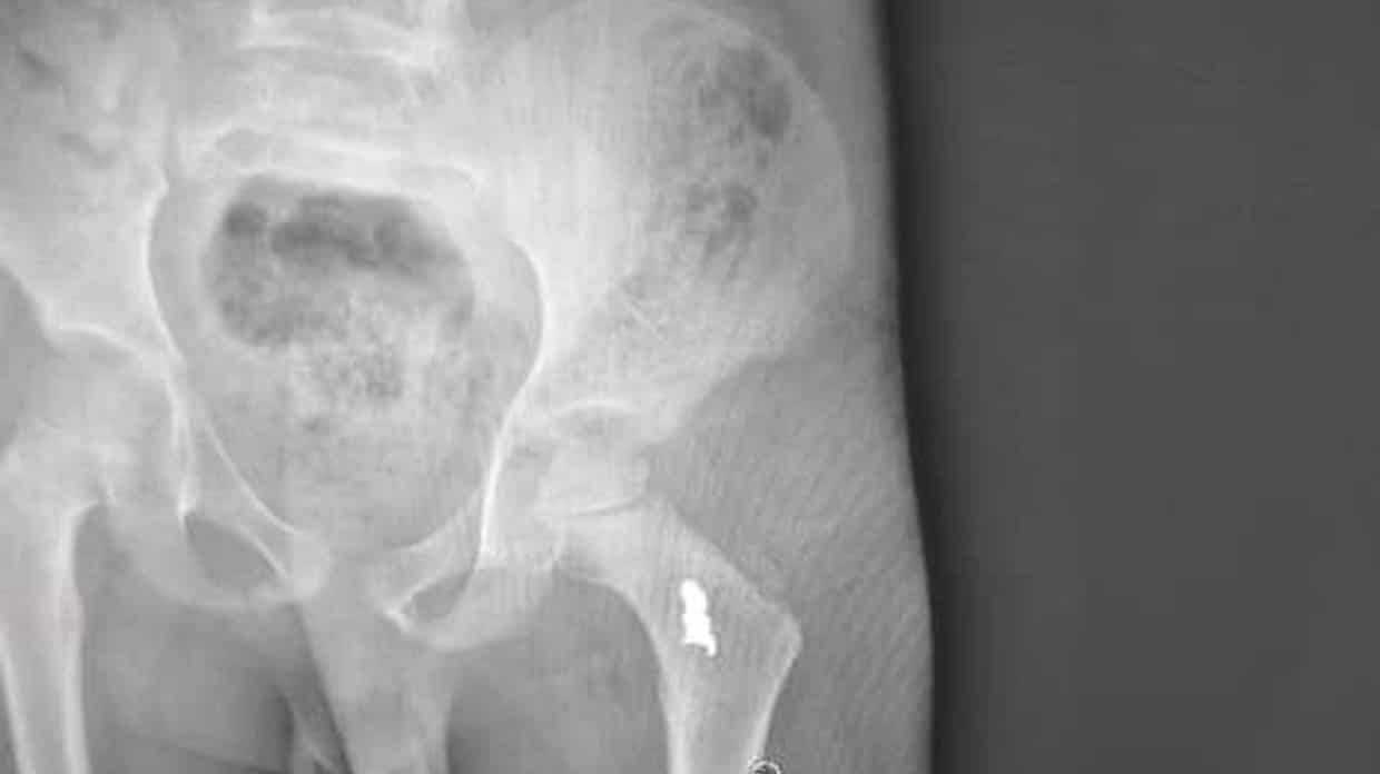 An X-ray of a boy’s thigh shows a foreign body near the hip socket