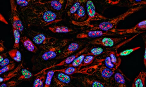 Immunofluorescence of cancer cells growing in 2D with nuclei in blue, cytoplasm in red and DNA damage foci in green.