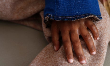 A malnourished child's hand