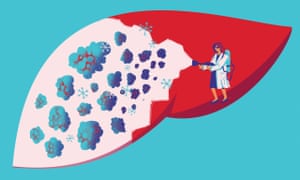How ablation destroys cancer to prolong lives