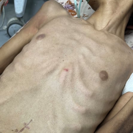 A 15-year-old malnourished boy with a pinhole wound in the middle of his chest.