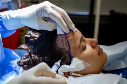 Hair transplant doctor operating on the forehead of a young woman