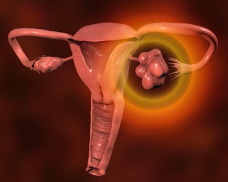 Illustration of ovaries with polyendocrine metabolic syndrome