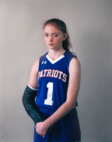 Girl in Patriots sports vest with her forearm in a cast and what appears to be a black eye stares into the camera