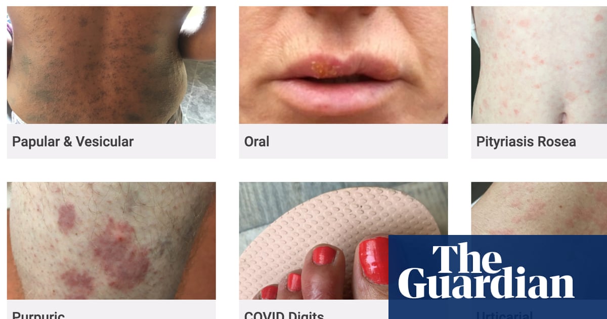 Covid-19 skin rash website criticised for lack of BAME examples