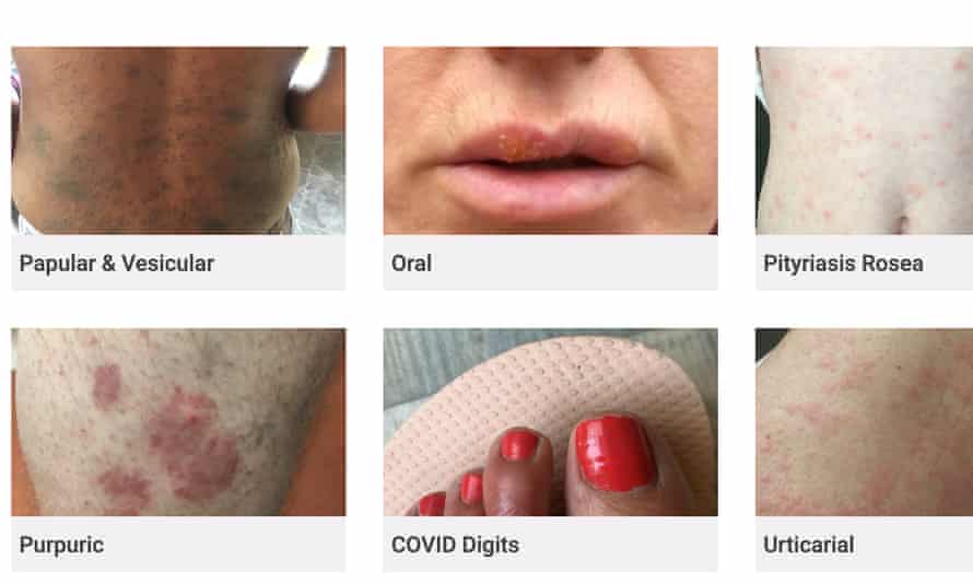Covid 19 Skin Rash Website Criticised For Lack Of Bame Examples