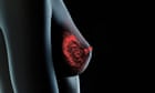 More than 400 chemicals in plastic products linked to breast cancer – study