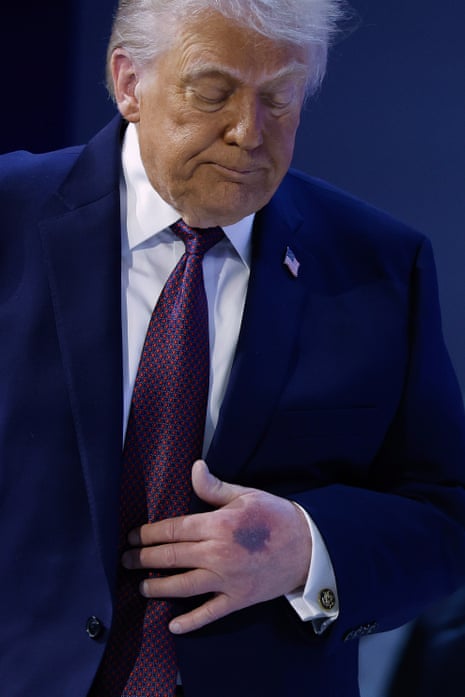 There was a prominent bruise on Donald Trump’s left hand in Davos, Switzerland on Thursday.