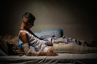A young man with a bandaged arm and leg cast lies on a bed in dim light