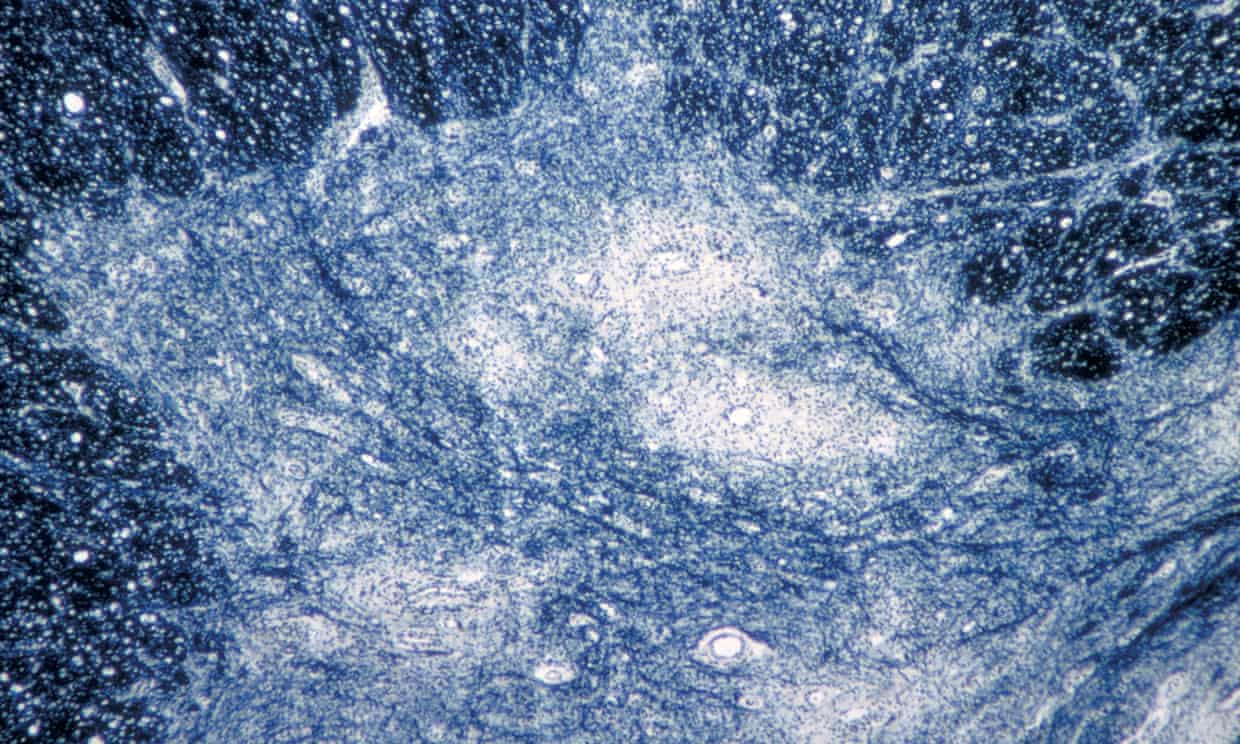 Polio found in New York wastewater month before confirmed case emerged (theguardian.com)