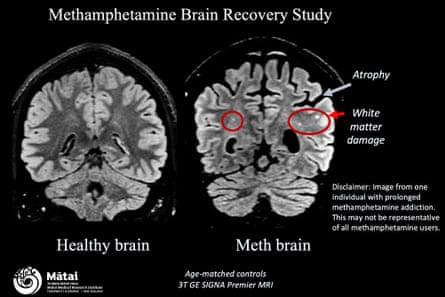 A comparison of two scans showing a healthy brain on the left and a methamphetamine damaged brain on the right