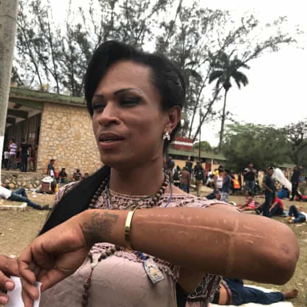 Shannel Smith shows the scar on her arm after a metal plate was inserted. As a trans woman, she suffered discrimination and attacks in her native Honduras.