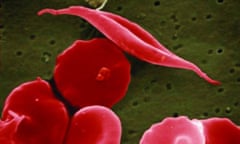 A blood cell altered by sickle cell disease.