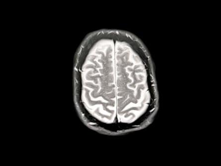 Scan of brain