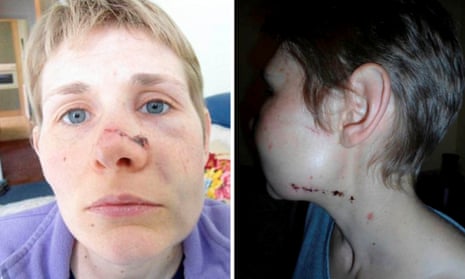 Helen Pearson’s injuries which she suffered at the hands of her stalker, Joseph Willis.