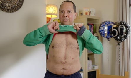 Cesar Franco, with 50th birthday balloons in the background, lifts up his jumper to show the scar running from the top of his chest to just above his bellybutton