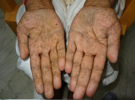 Skin lesions from arsenic poisoning