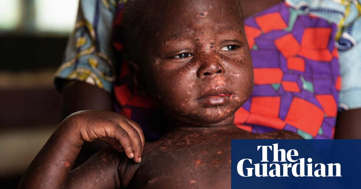 Measles stalks Central African Republic in Covid’s shadow in pictures