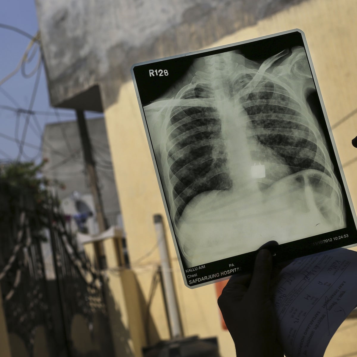 Tuberculosis Deaths Rise But Global Fight Against Disease Is Paying Off Report Says Global Development The Guardian