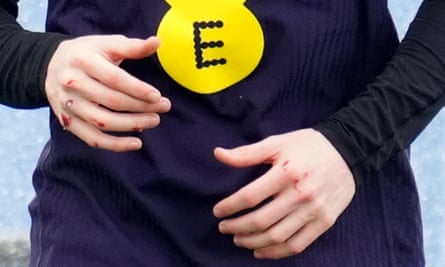 Damage visible on Anthony Gordon’s hands.