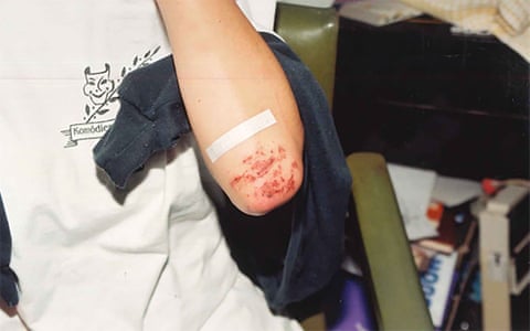 Grazes on an elbow