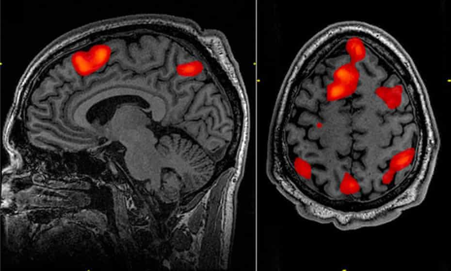 fMRI scan of the brain during memory tasks.