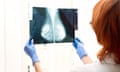 new research about breast cancer