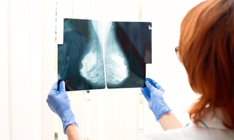 ‘Mammograms are unable to properly see 40-50% of dense breast tissue.’