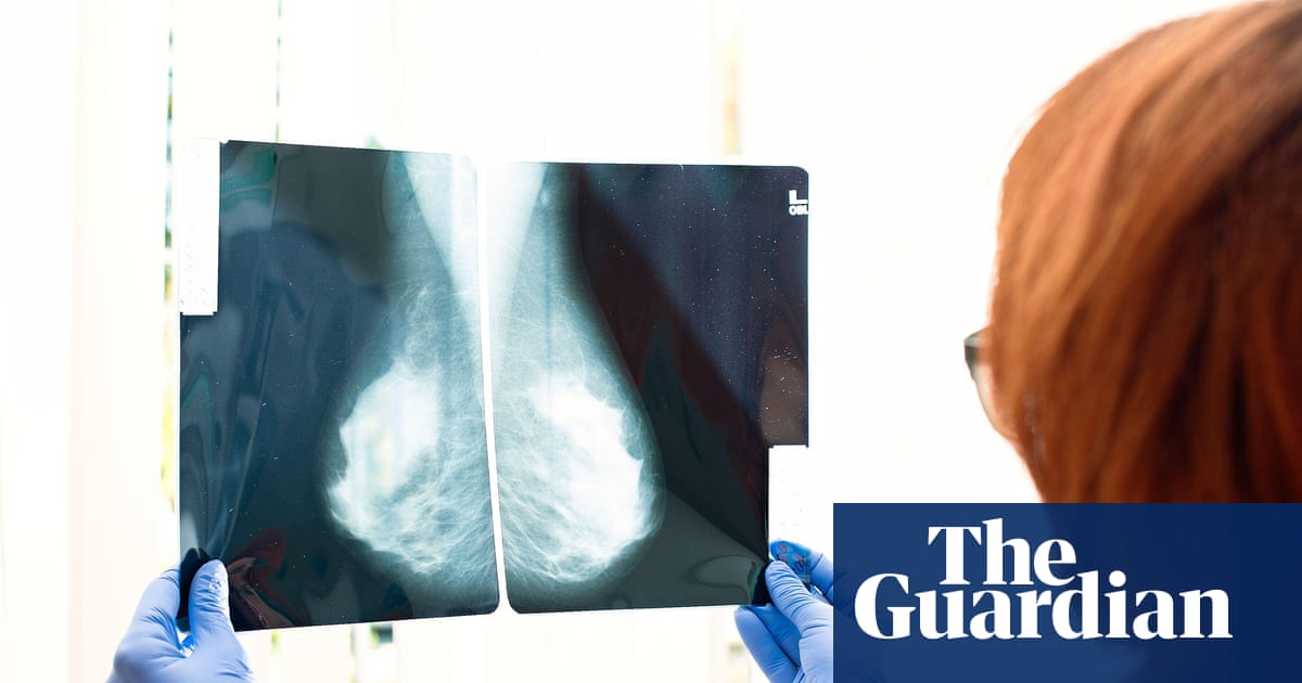 Discussing breast density after mammograms may cause unneeded anxiety, study finds