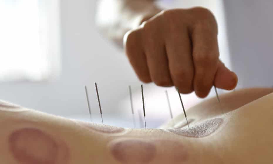 A person gets acupuncture therapy on the back