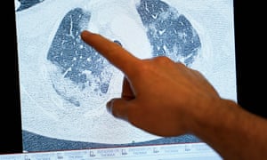 Covid Patients Have Lung Damage Weeks After Leaving Hospital World News The Guardian