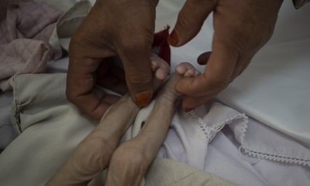 A malnourished four-year-old boy receives attention at the Indira Gandhi hospital in Kabul.