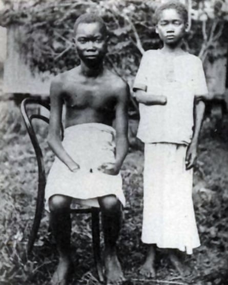 Congolees amputees, pictured about 1900. Amputation was frequently used as punishment in the Congo Free State, controlled by Leopold II.
