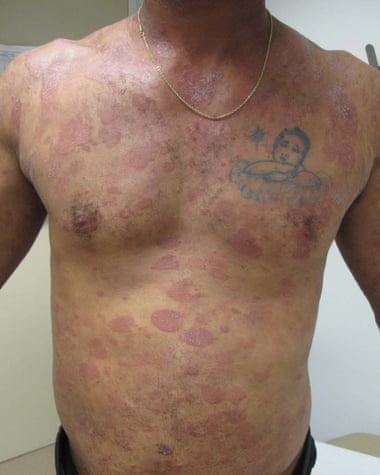 Dewayne Johnson developed lesions on his body and cancer after exposure to Monsanto products.