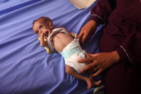 A Palestinian child suffering from malnutrition due to starvation is seen at al-Rantisi hospital in northern Gaza City.
