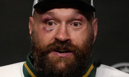 Tyson Fury sports a bruised eye while speaking to the media after his second loss to Oleksandr Usyk.