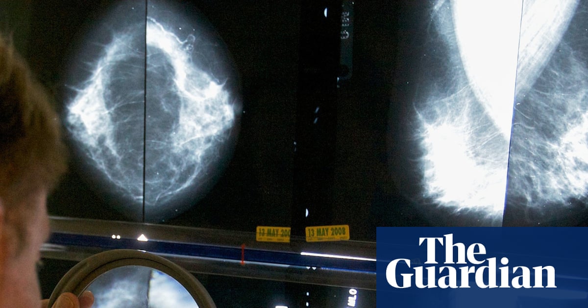 GPs’ breast cancer guidelines ‘miss’ 95% of women who will develop disease