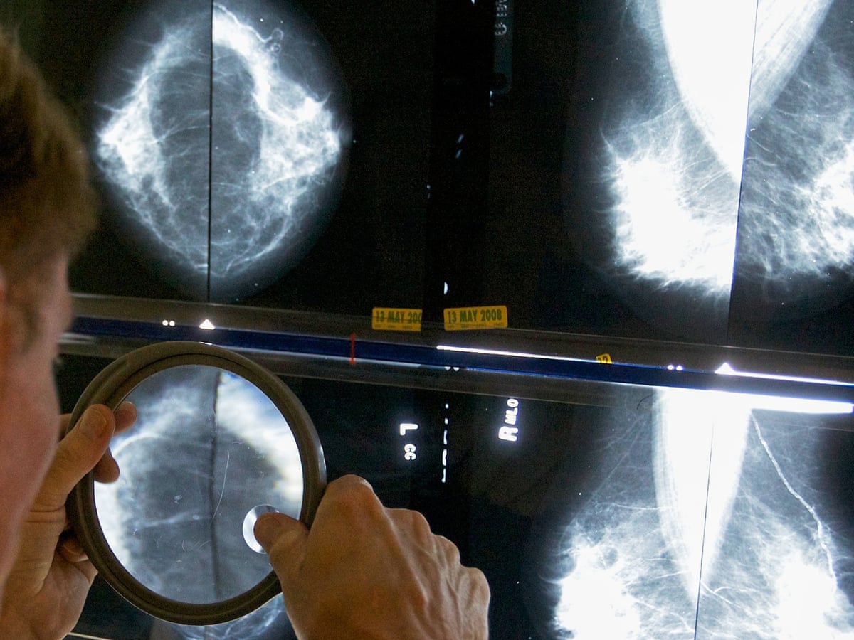 GPs' breast cancer guidelines 'miss' 95% of women who will develop disease | Breast cancer | The Guardian