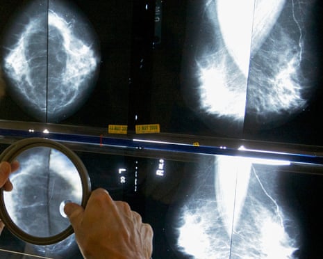 A radiologist uses a magnifying glass to examine mammograms for breast cancer.