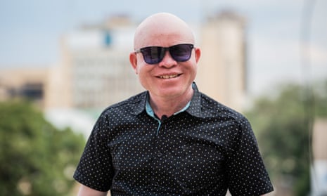 A fire inside me': the Zambian singer who overcame prejudice to change  attitudes to albinism, Albinism