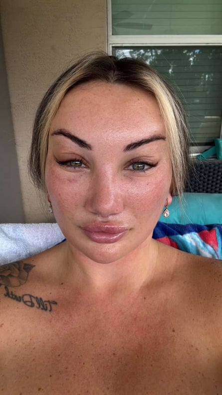 Amanda Preisinger, 12 days after her facelift