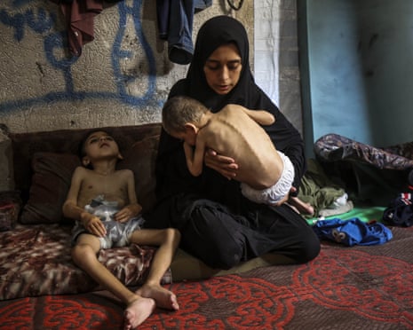 Six-year-old Yusuf Abdurrahman Matar and his four-year-old brother Emir Abdurrahman Matar face life-threatening malnutrition amid the deepening humanitarian crisis in Gaza City.